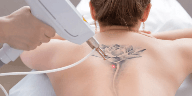 Remoção de tatuagens